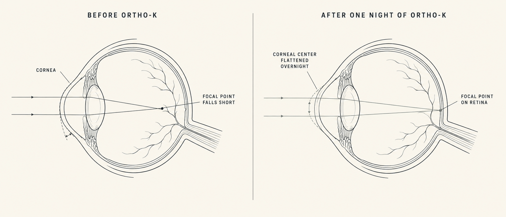 Diagram showing how ortho-k reshaping shifts the focal point from in front of the retina to directly on it, correcting nearsightedness.