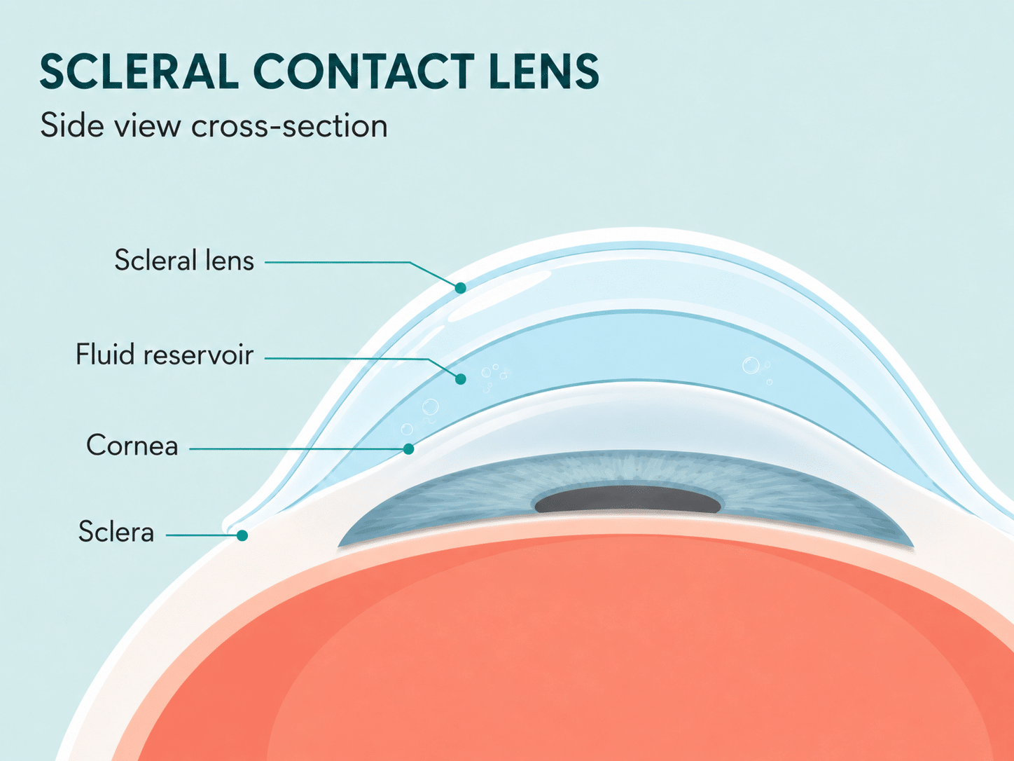 Cross-section diagram of a scleral contact lens vaulting over the cornea with a fluid reservoir beneath it, resting on the white of the eye